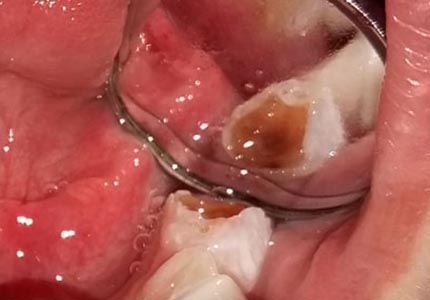Endodoncia en Niños. Terapias Pulpares en Dientes Primarios 2022 1A