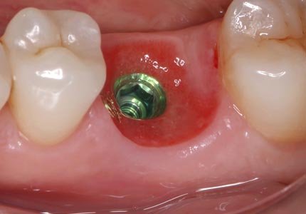 Restauraciones sobre Implantes 2024 1A