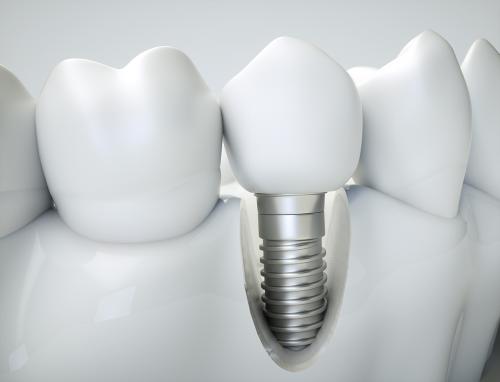 Rehabilitación Oral con Implantes 2019