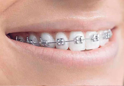 Ortodoncia Sistema MBT 2026 1A