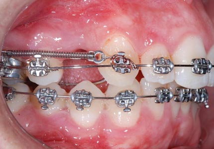 Extracciones en Ortodoncia 2026 1A